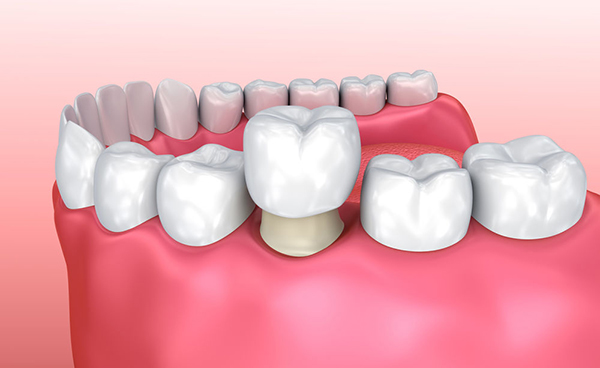 dental crown cap diagram restorative dentistry strengthening teeth structure restoration porcelain fused to metal natural color appearance general treatment